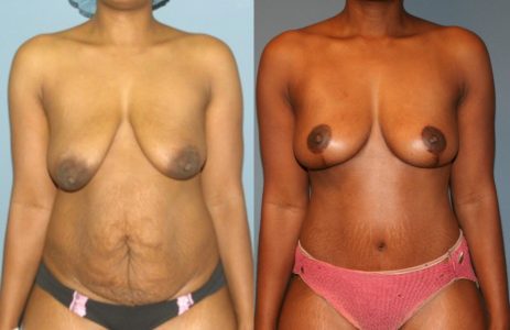 Post Weight Loss Surgery Example Post Weight Loss Surgery Example